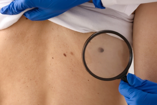 Mole Removal Treatment